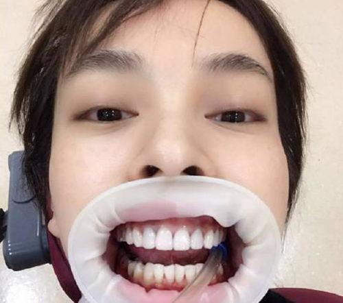 何炅以前的牙齿照片,从青涩少年到魅力大叔的蜕变之路